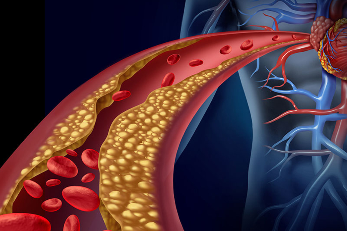 Hyperlipidaemia
